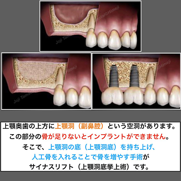 サイナスリフト（上顎洞底挙上術）とは？