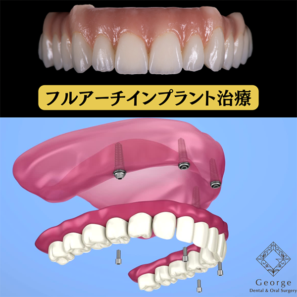 姫路でフルアーチインプラント（オールオン4・オールオン6）を検討中の方へ― 人生最後まで“噛める喜び”を ―