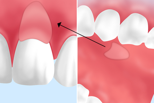 歯ぐきの形成治療