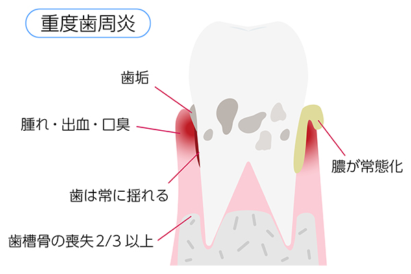 歯周病は「骨」の病気