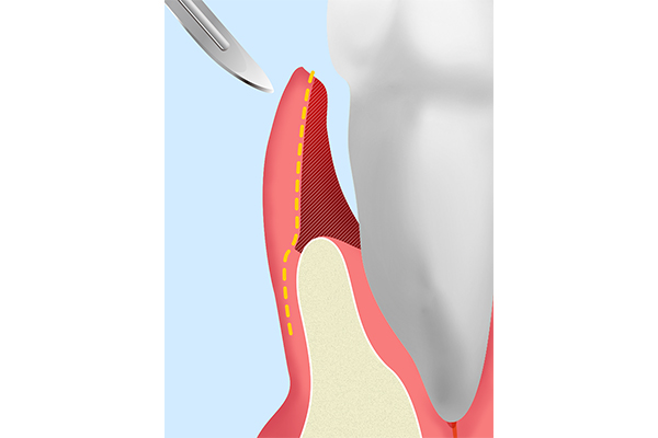 歯肉剥離掻爬術（FOP）・歯肉弁移動術（APF）