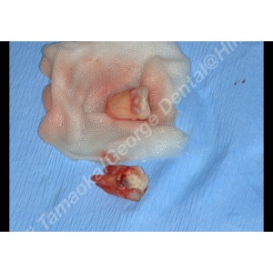 歯の移植症例