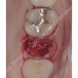 歯の移植症例