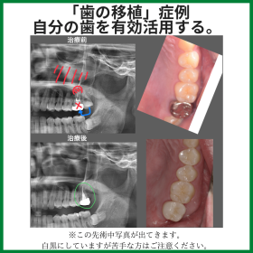 歯の移植症例②