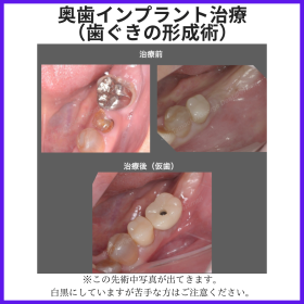奥歯インプラント治療（歯ぐきの形成術）