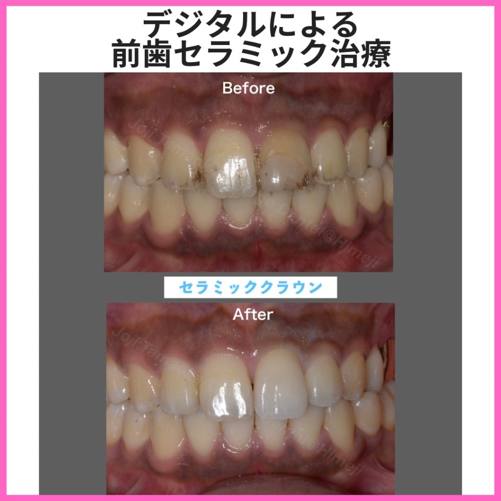デジタルによる前歯審美セラミック治療