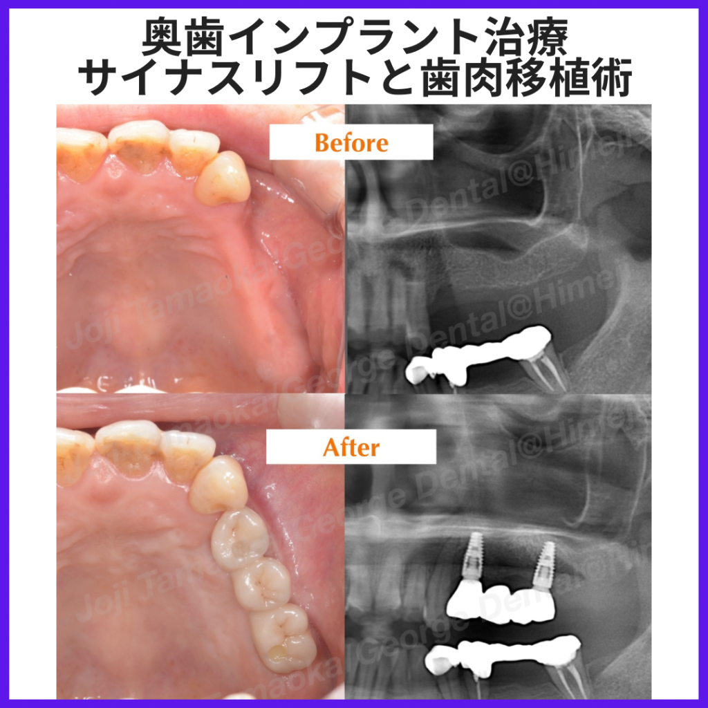 奥歯インプラント治療（サイナスリフト＋遊離歯肉移植術）