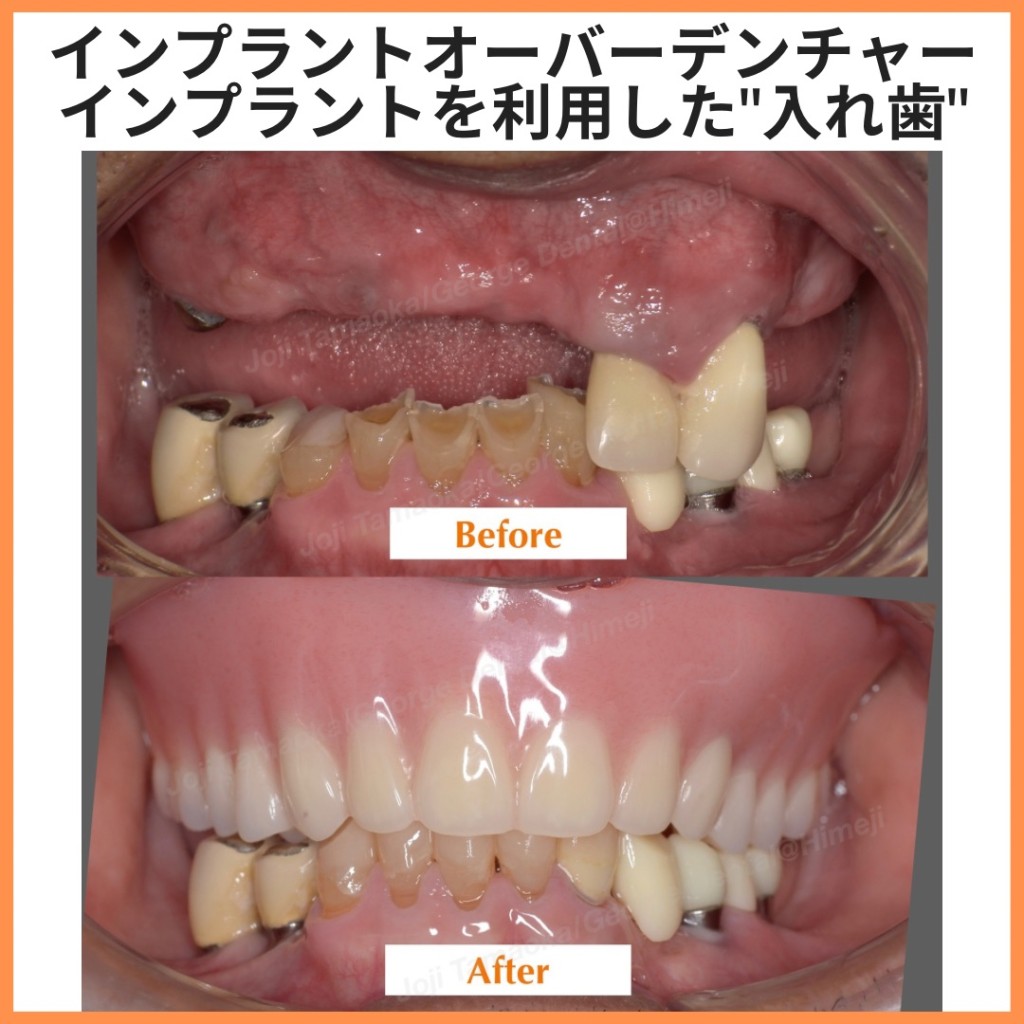 インプラントオーバーデンチャー(インプラントを利用した入れ歯入れ歯）
