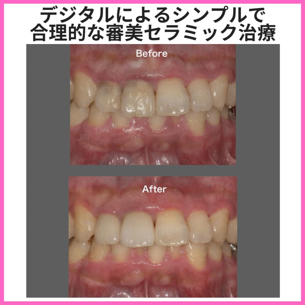 デジタルによるシンプルで合理的な審美セラミック治療