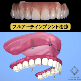 姫路でフルアーチインプラント（オールオン4・オールオン6）を検討中の方へ― 人生最後まで“噛める喜び”を ―
