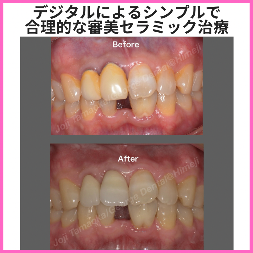 デジタルによるシンプルで合理的な審美セラミック治療②