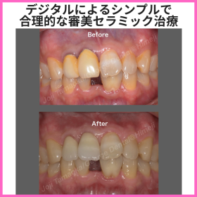デジタルによるシンプルで合理的な審美セラミック治療②