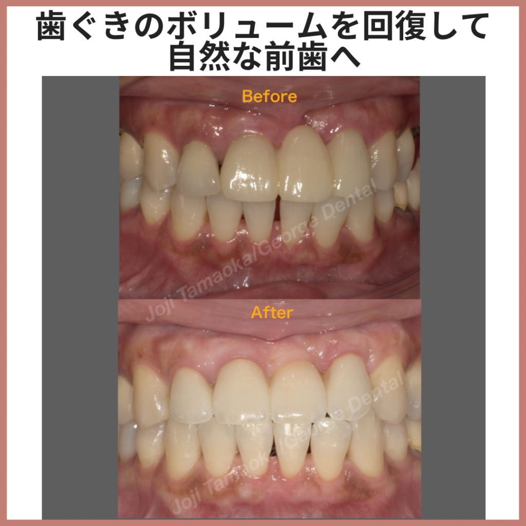 歯ぐきのボリュームを回復して、自然な前歯へ