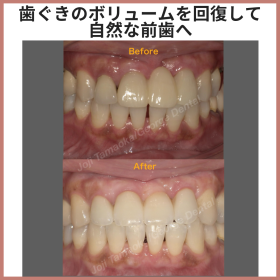 歯ぐきのボリュームを回復して、自然な前歯へ