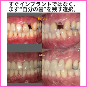 「すぐインプラントではなく、まず“自分の歯”を残す選択。」― 矯正的挺出と歯冠長延長術による保存的治療 ―