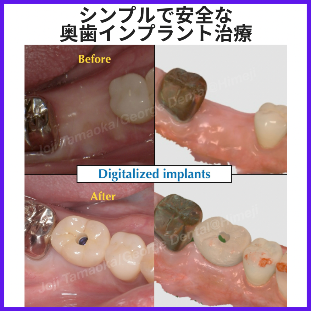 シンプルで安全な奥歯インプラント治療