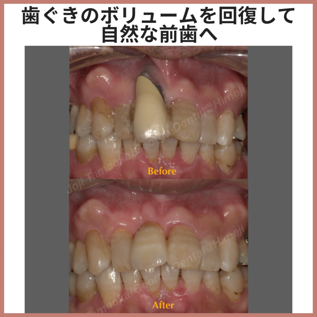 歯槽堤のボリュームを回復し、自然な前歯形態を再建