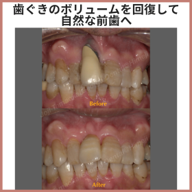 歯槽堤のボリュームを回復し、自然な前歯形態を再建