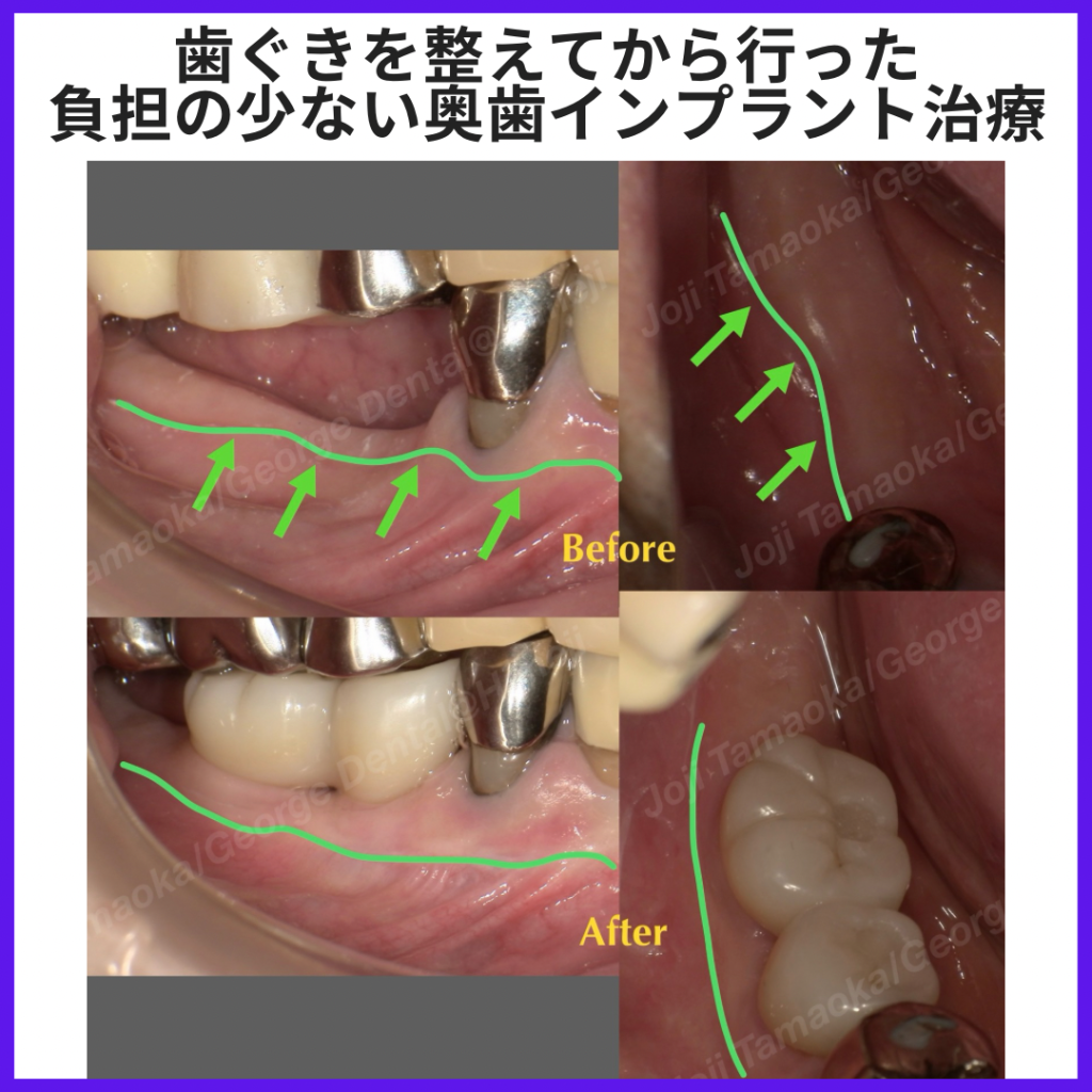 歯ぐきを整えてから行った、負担の少ない奥歯インプラント治療