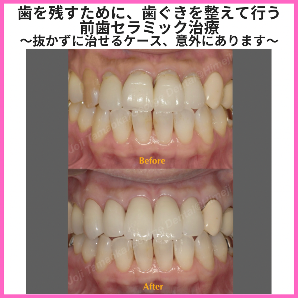 歯を残すために、歯ぐきを整えて行う前歯セラミック治療 〜抜かずに治せるケース、意外にあります〜