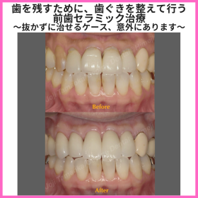 歯を残すために、歯ぐきを整えて行う前歯セラミック治療 〜抜かずに治せるケース、意外にあります〜