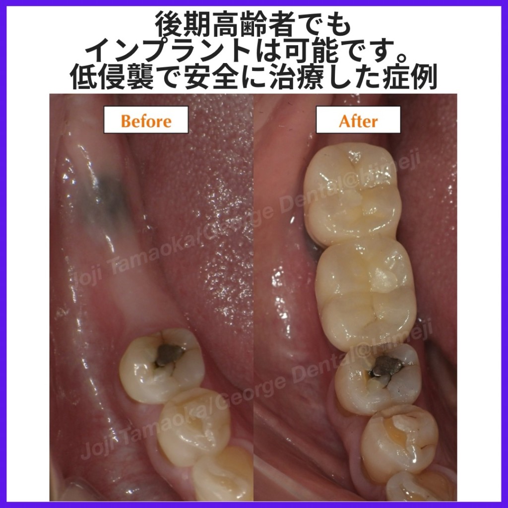 後期高齢者でもインプラントは可能です。低侵襲で安全に治療した症例