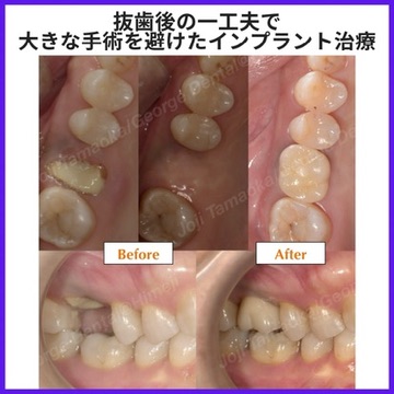 抜歯後の一工夫で大きな手術を避けたインプラント治療