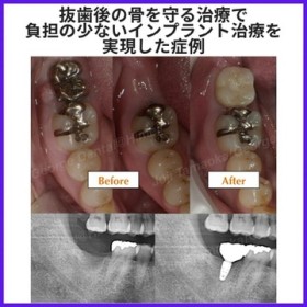 抜歯後の骨を守る『ソケットプリザベーション』で負担の少ないインプラント治療を実現した症例