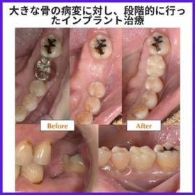 大きな骨の病変に対し、段階的に行ったインプラント治療