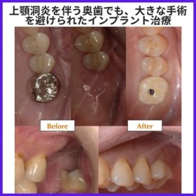 上顎洞炎を伴う奥歯でも、大きな手術を避けられたインプラント治療