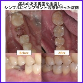 痛みのある奥歯を抜歯し、シンプルにインプラント治療を行った症例