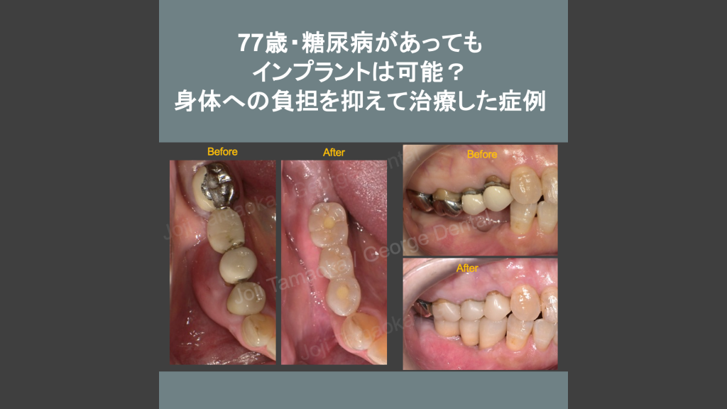 77歳・糖尿病があってもインプラントは可能？身体への負担を抑えて治療した症例