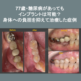 77歳・糖尿病があってもインプラントは可能？身体への負担を抑えて治療した症例
